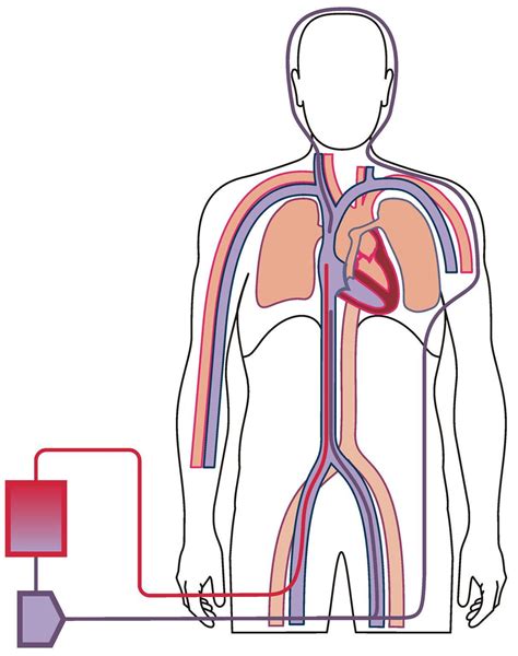 Configurations of ECMO – Alfred ECMO Guideline