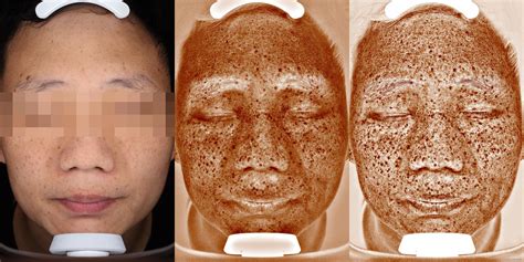 浅析美业皮肤检测仪图像算法_皮肤特征增强算法-CSDN博客