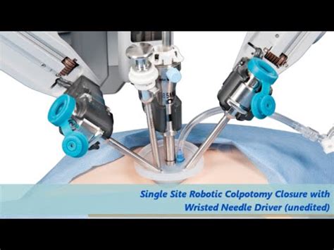 Colpotomy Procedure 的图像结果