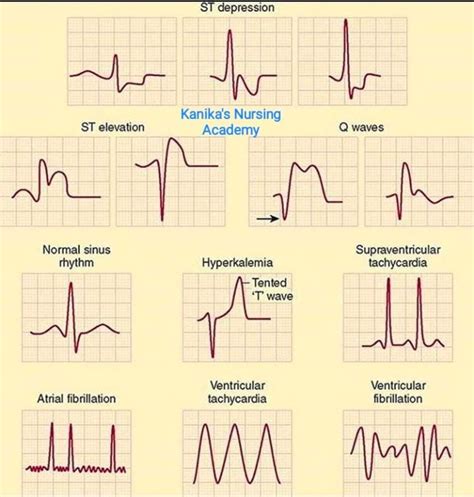 Abnormal ECG patterns - Kanika's Nursing Academy