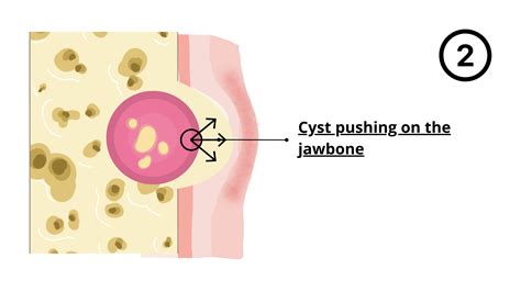 Wisdom Tooth Cyst Removal 的图像结果