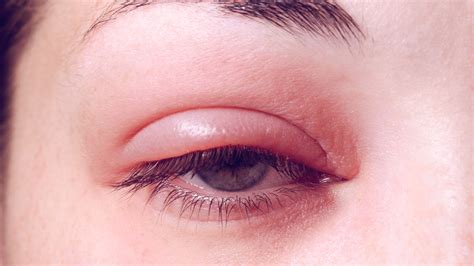 How to Recognize the Signs of Common Eye Infections