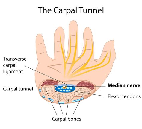 carpal tunnel surgery recovery