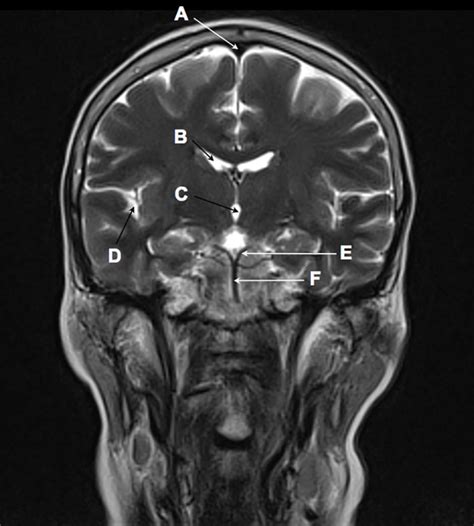 Coronal T2 weighted magnetic resonance image of the brain | The BMJ