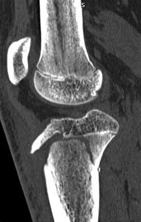 Imaging Review of Adolescent Tibial Tuberosity Fractures