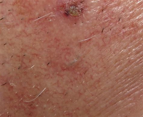 How to get rid of ingrown hair and ingrown hair prevention