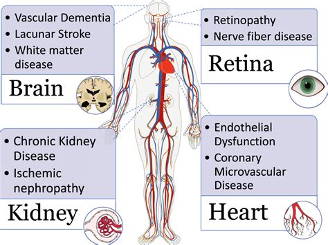 Small‐Vessel Disease in the Heart and Brain: Current Knowledge, Unmet ...