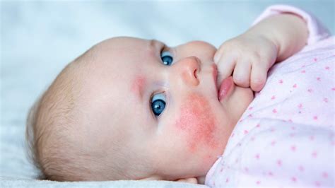 How to diagnose and manage cow’s milk protein allergy in infants - Healthed