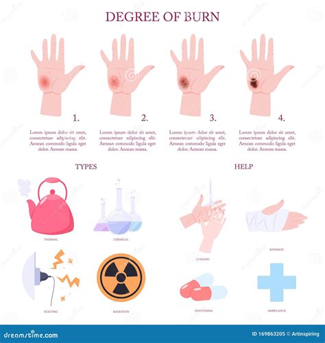 Skin Burn Injury Treatment and Stages Infographic. Stock Vector - Illustration of bandage, hurt ...