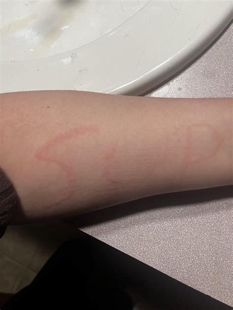 Not always like this : r/Dermatographia