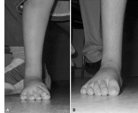 A-B (A) This picture shows the preoperative right foot appearance in a... | Download Scientific ...