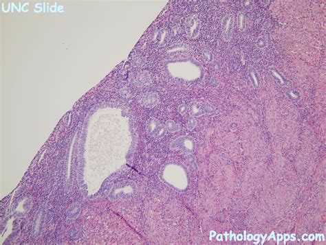 Image result for Disordered Proliferative Endometrium