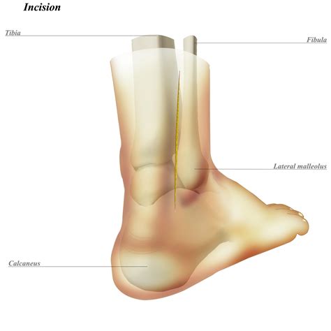 Ankle Posterolateral Approach - Approaches - Orthobullets