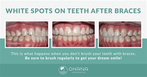 Bad Teeth Before And After Braces