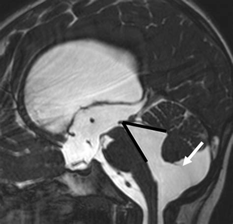 Mega Cisterna Magna Vs Arachnoid Cyst