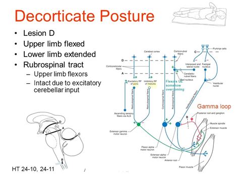 Image result for Decorticate Posture