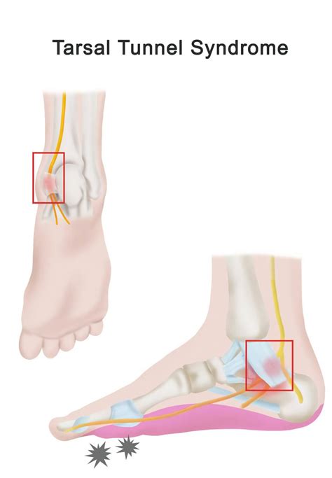 Nerve Glides For Tarsal Tunnel Syndrome at Fred Rollins blog - tarsal tunnel syndrome treatments