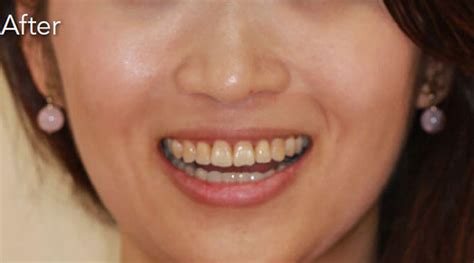 Invisalign in Gurgaon | Invisible Braces Treatment Cost in Gurgaon