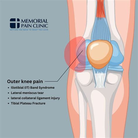 Outer Knee Pain