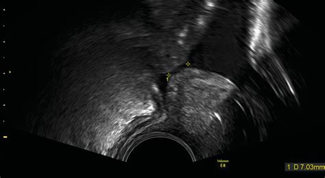 Zervixmessung und Prävention der Frühgeburt - Gynäkologie ...