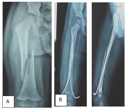 A study of titanium elastic nailing in the surgical management of ...