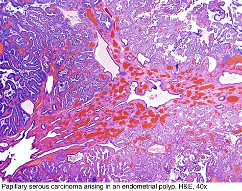 Pathology Outlines - Endometrial polyp