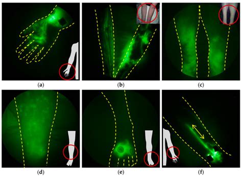 The Development and Treatment of Lymphatic Dysfunction in Cancer ...