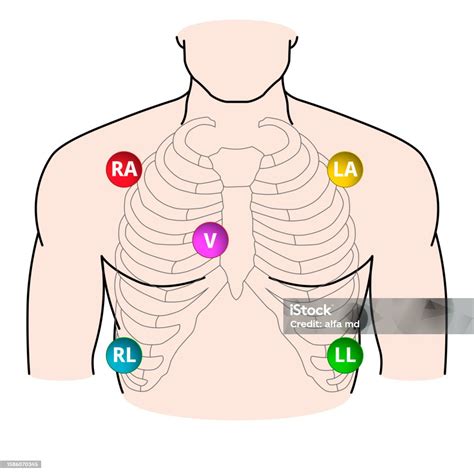 5 Lead Electrode Placement Electrocardiogram Ra La Rl Ll V Position Of ...