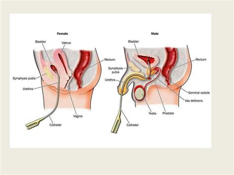 Image result for Catheterization Process