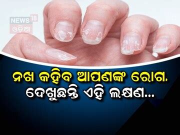 Nail Signs Warning: ଏହି ସଙ୍କେତ ଭାରି ଖରାପ! ନଖ କହିବ ଆପଣଙ୍କ ରୋଗ... Nail ...