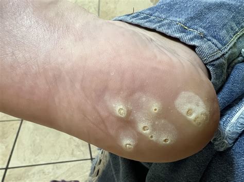 Image result for How Does Compound W Work