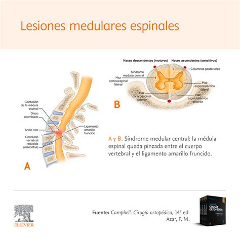 Tratamiento De Lesiones Medulares