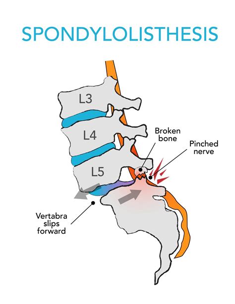 6 best spondylolisthesis exercises and 3 to avoid – Artofit