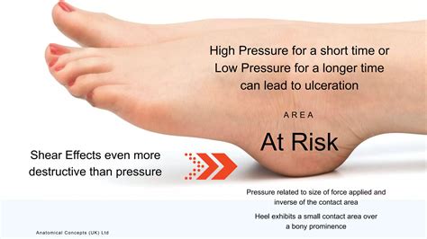 Prevention of Heel Pressure Ulcers | PPT