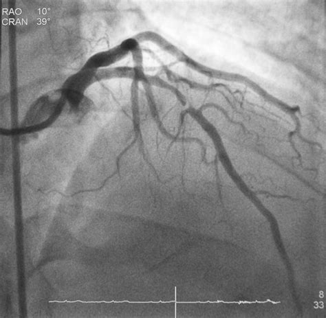 Coronary Angiogram Procedure 的图像结果