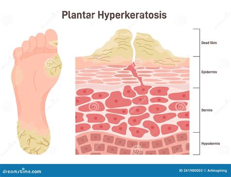 Plantar Hyperkeratosis. Feet Corns and Calluses, Medical Condition ...
