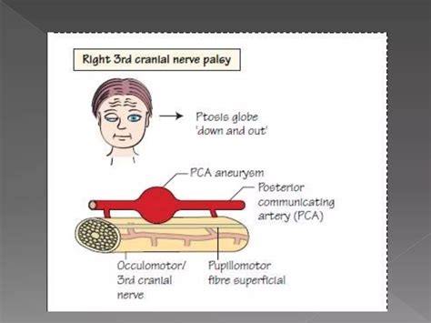 Cranial Nerve 3 Palsy Eye – Third Nerve Palsy – XBVYA