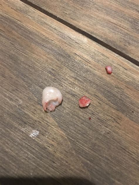 Bye bye 2 pilar cysts : r/popping