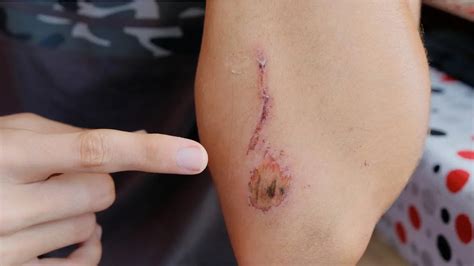Accelerate Wound Healing treatment Process naturally – Gencleus