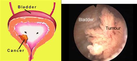 Bladder Cancer 的图像结果