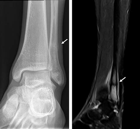 Stress fracture of the distal fibula. (a) Conventional coronal ...