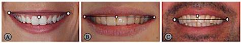 The Interference of Age and Gender on Smile Characterization Analyzed ...