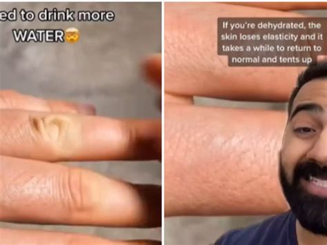 Doctor's Skin Pinch Test Will Tell You If You're Dehydrated