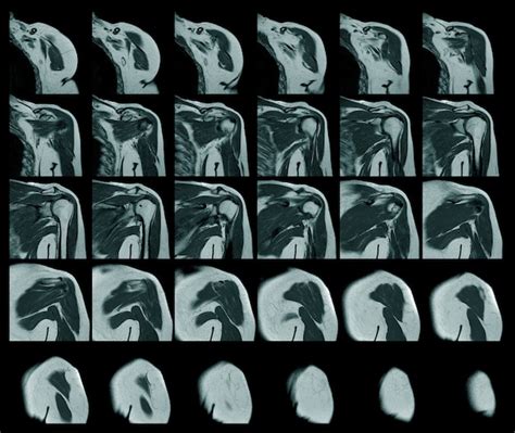 左肩の科学と教育の脂肪腫が疑われるMRI左肩腱板断裂 | Premium写真