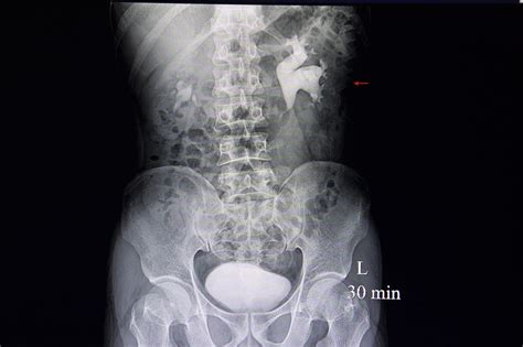Kidney Stone Ultrasound Kidney Stones Are Hard Deposits That Form In