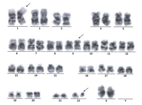 Long-Term Molecular Remission after Treatment with Imatinib in a ...