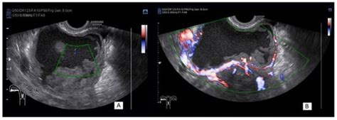 Sonographic Assessment of Complex Ultrasound Morphology Adnexal Tumors ...