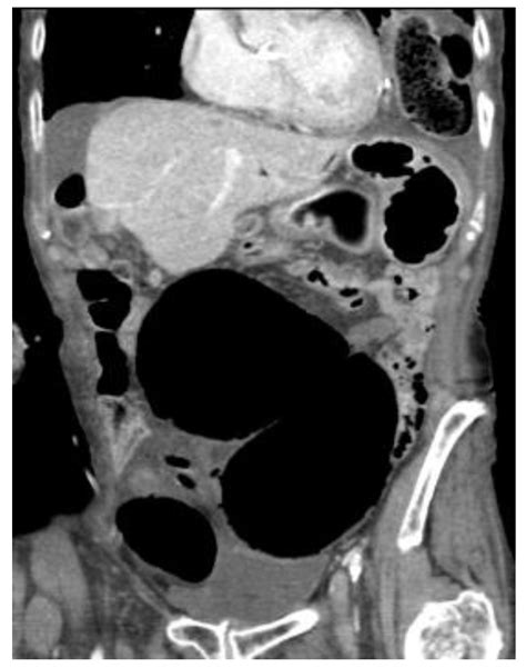 Caecal Volvulus: A District General Hospital Experience and Review of ...