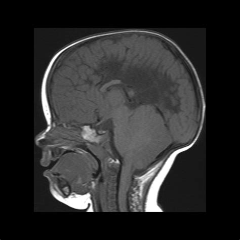 Arnold Chiari Malformation Type 2 Mri
