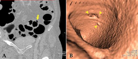 Image result for Colonic Diverticulum CT